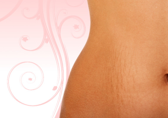 Stretch Marks - Causes and How to Get Rid of Stretch Marks