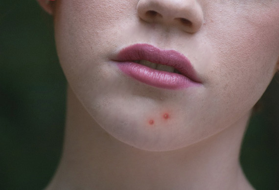 What Exactly Causes Acne - How and Why Acne Happens